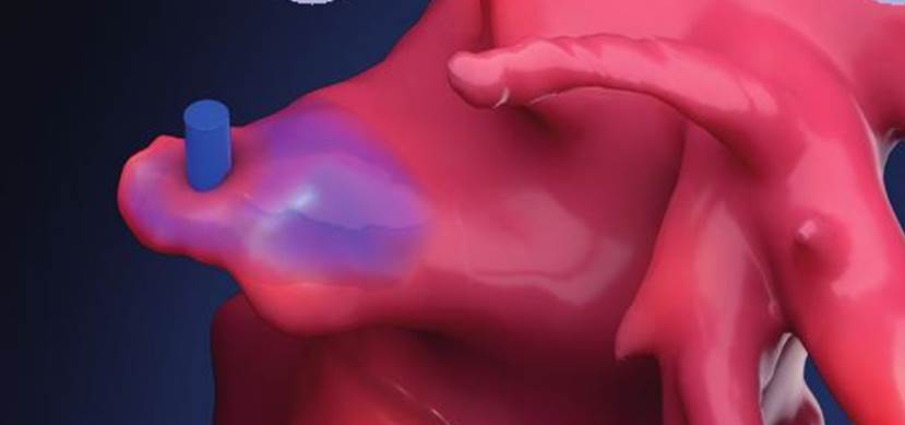 A soft, patient-specific left atrial appendage occluder